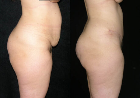 Tummy Tuck case #3529