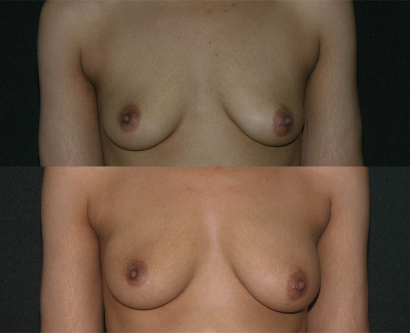 Breast Augmentation Fat Transfer case #3474