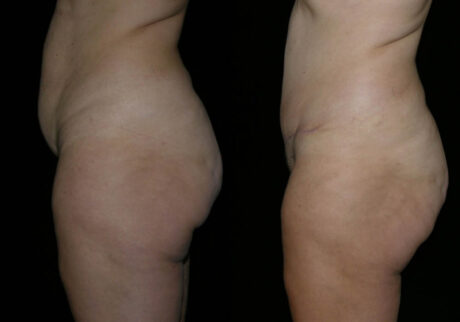 Tummy Tuck case #3532