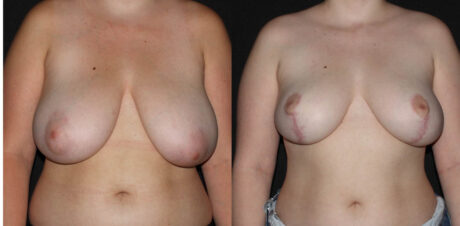 Breast Reduction case #3492