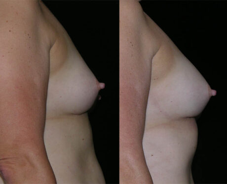 Breast Augmentation Fat Transfer case #3472