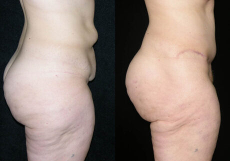 Tummy Tuck case #3536