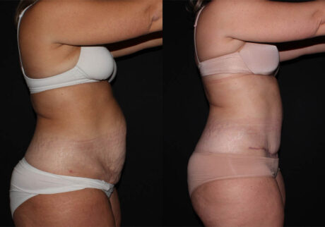 Tummy Tuck case #3538