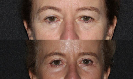 Blepharoplasty case #3450