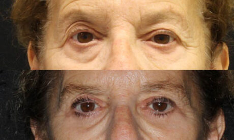 Blepharoplasty case #3456