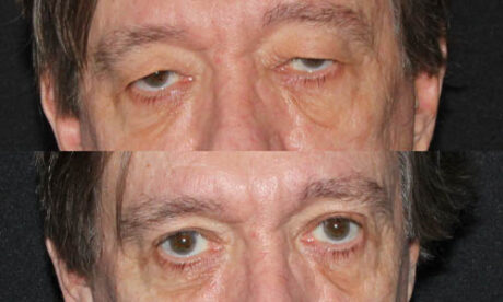 Blepharoplasty case #3460