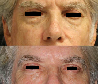 Blepharoplasty case #38383