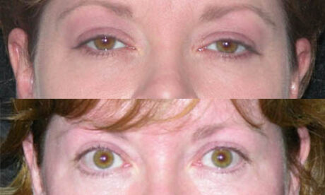 Blepharoplasty case #3458