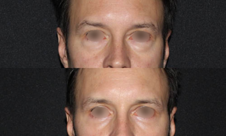 Blepharoplasty case #3448