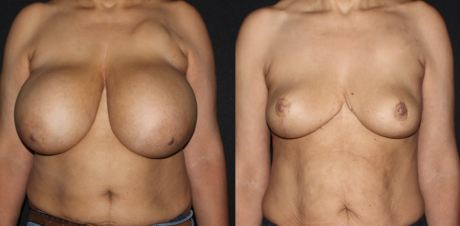 Breast Augmentation case #3478