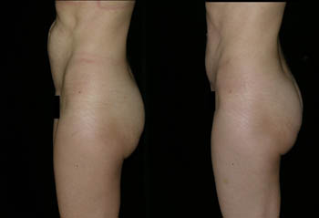 _0000_Abdominoplasty_3_25_full-1.jpg