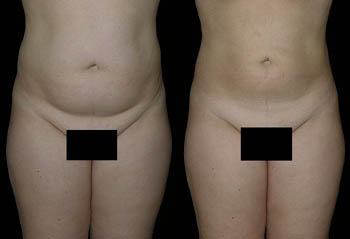 _0001_Z-Liposuction-female2.jpg