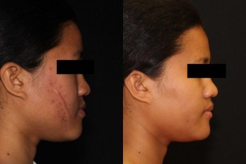 25-yo-before-and-6-months-sp-excision-and-repair-of-facial-scar-20150326131308988-20160822100323874-e1471883595924