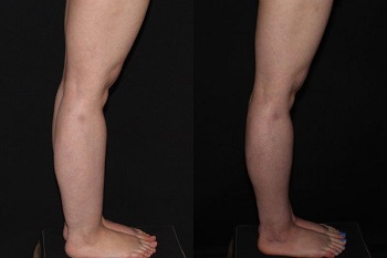 Cankles: Calf and Ankle Liposuction case #37849