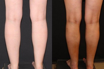 Cankles: Calf and Ankle Liposuction case #37847