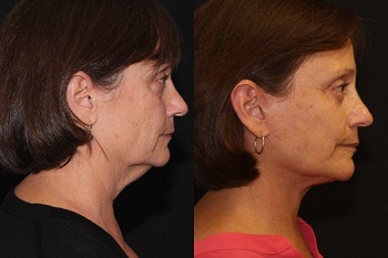 Facelift case #37558