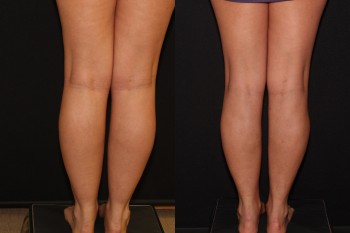 Cankles: Calf and Ankle Liposuction case #37843