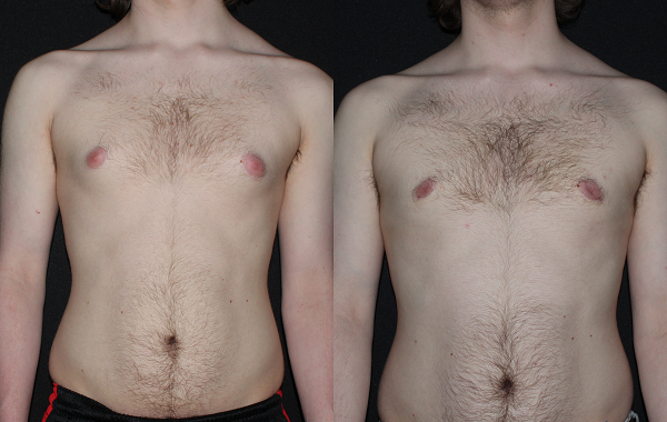 Gynecomastiafront10495-1