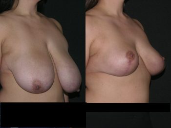 Breast Reduction case #37730