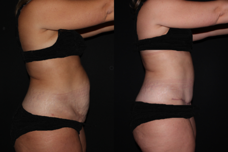 Tummy Tuck case #37784