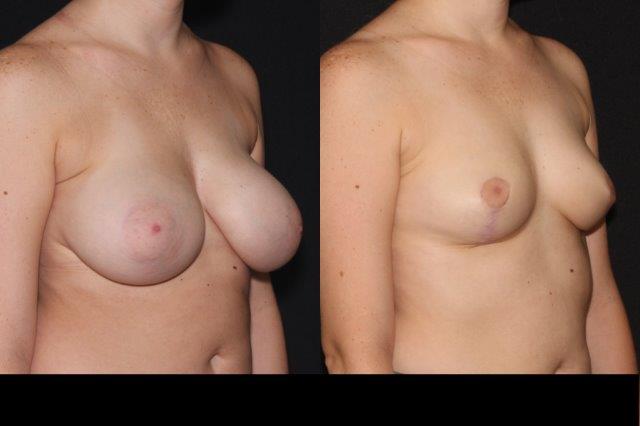 Breast Reduction case #37723