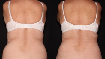 Coolsculpting case #37952