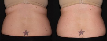 Coolsculpting case #37951