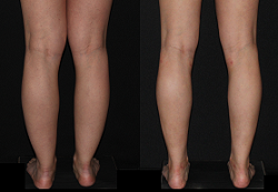 Cankles: Calf and Ankle Liposuction case #37841