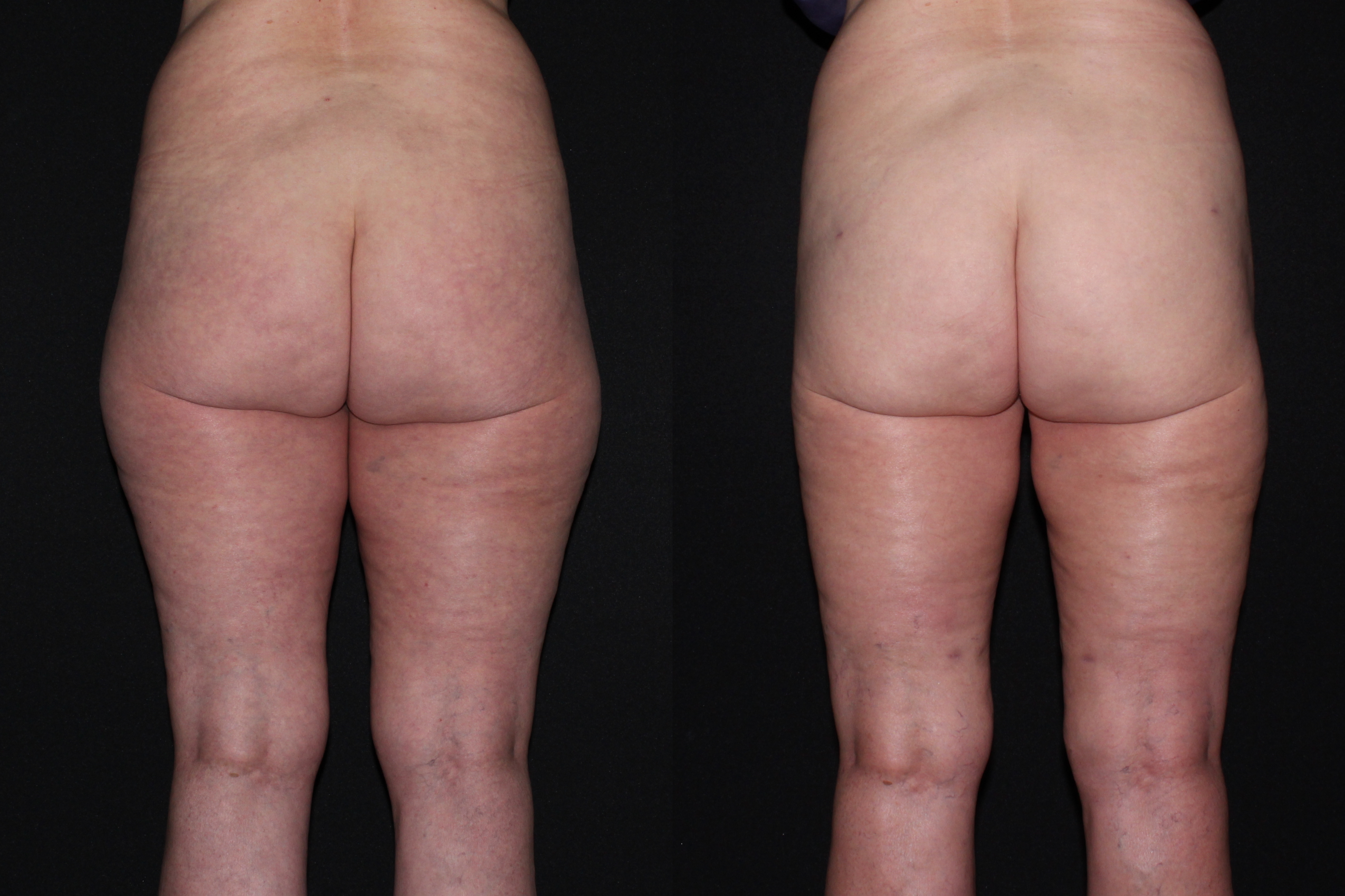 Before and 5 months after lipo of inner and outer thighs and hips and medial knees