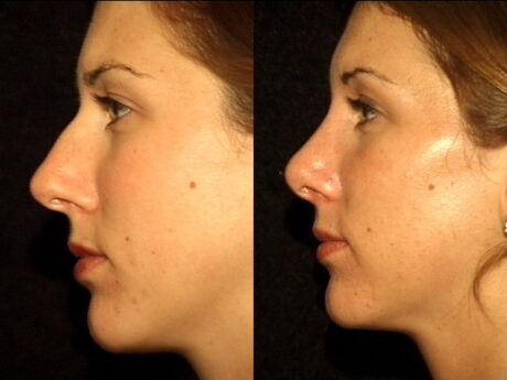 Rhinoplasty case #37587