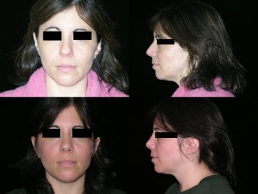 Rhinoplasty case #37588