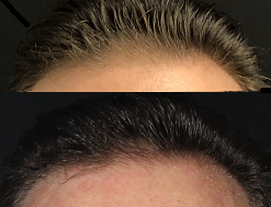 Hair Restoration case #37975