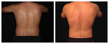 Coolsculpting case #37949