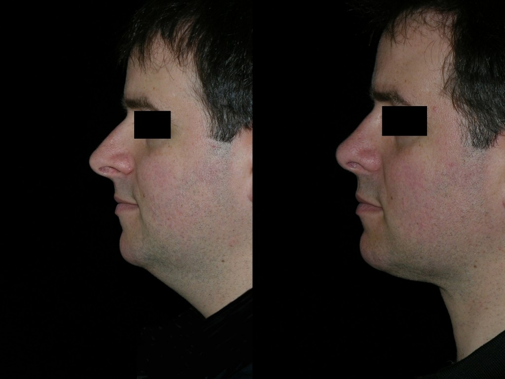 Before and after neck lipectomy and rhinoplasty side view.