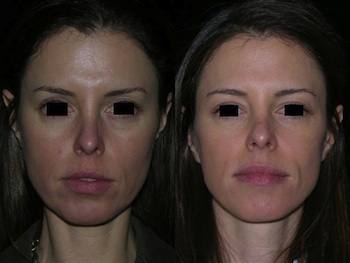 Dermal Filler case #37565