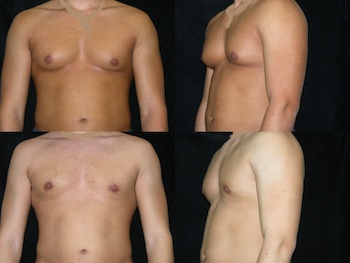 Gynecomastia (Male Breast Reduction) case #37779