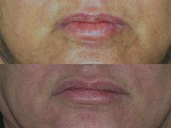 Dermal Filler case #38101