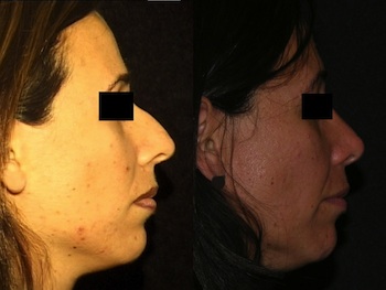 Rhinoplasty case #37592