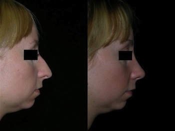 Rhinoplasty case #37591