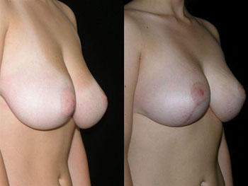 Breast Reduction case #37725