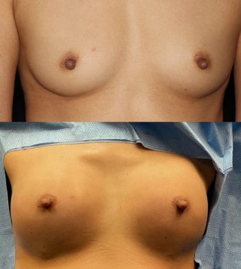 Breast Augmentation Fat Transfer case #37695