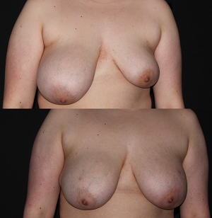 breast-asymmetrybreastlipofattransfer-20150409131627089-20221209110119943-1