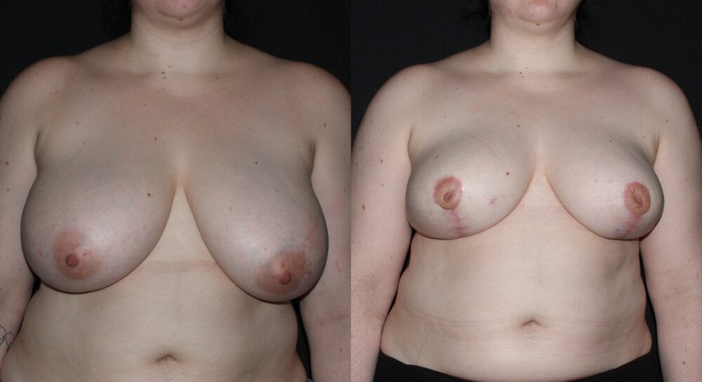 Breast Reduction case #37717