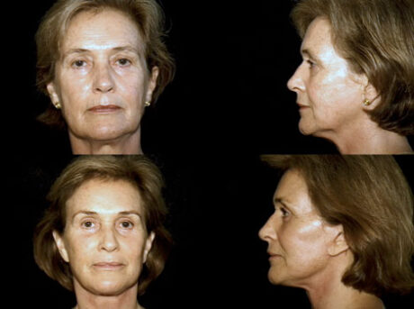 Facelift case #37563