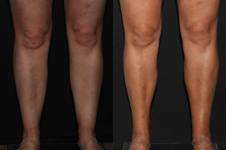 Cankles: Calf and Ankle Liposuction case #37842