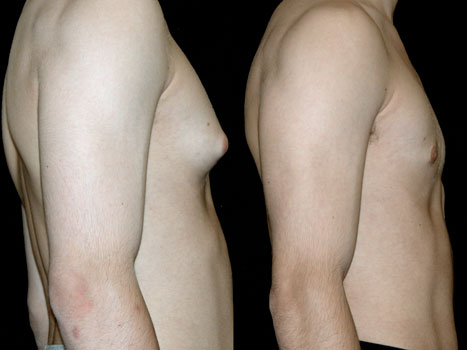 gynecomastia1_before_and_after