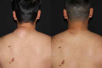 Minimal Scar Lipoma Removal case #37924