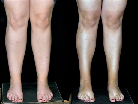 Cankles: Calf and Ankle Liposuction case #37851