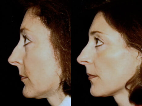 Microdermabrasion case #38099