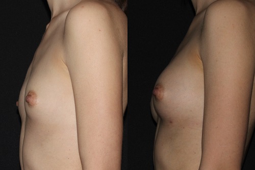 naturalbreastaugmentation